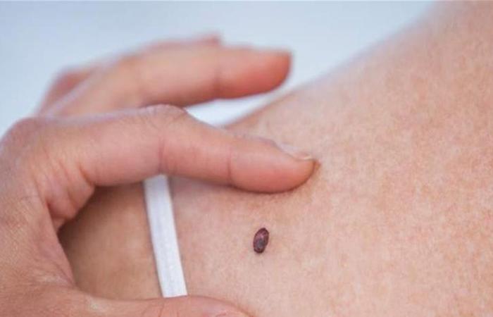 متى تصبح الشامة مقلقة؟
