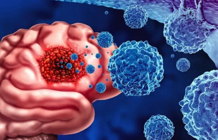 أورام الدماغ بين الأولية والثانوية… وهذه أبرز الإشارات التحذيرية