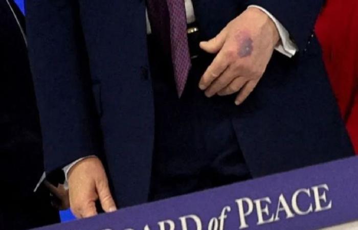 تضارب في رواية “كدمة ترامب”