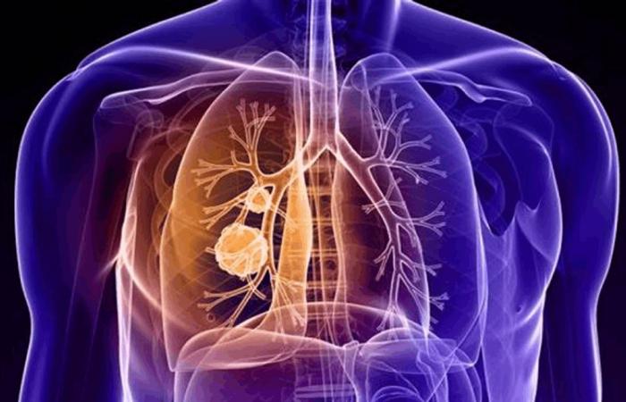 علماء يكتشفون آلية دفاع الخلايا السرطانية ضد العلاج