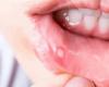 "تقرّحات الفم".. أطعمة تزيد الألم وأخرى ألطف على الجرح
